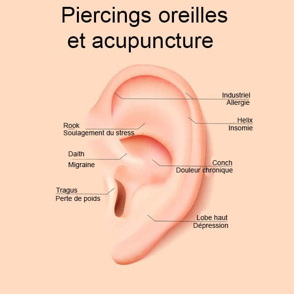 Soigner les acouphènes par l'acupuncture - Optical Center