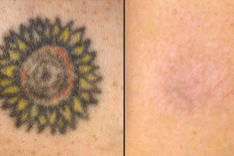 Effacer un tatouage, comment faire ? Magazine Tarawa Lifestyle